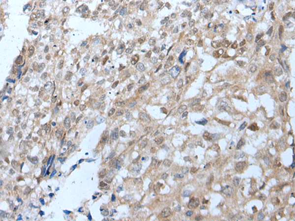 Immunohistochemistry of paraffin-embedded Human lung cancer tissue  using VPS35 Polyclonal Antibody at dilution of 1:25(×200)