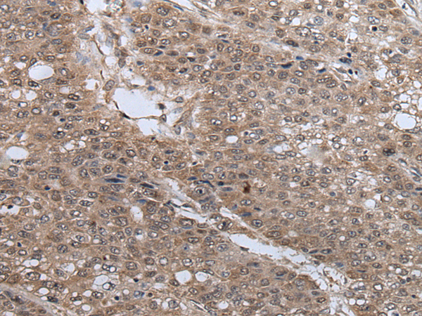 Immunohistochemistry of paraffin-embedded Human liver cancer tissue  using UBE4B Polyclonal Antibody at dilution of 1:40(×200)