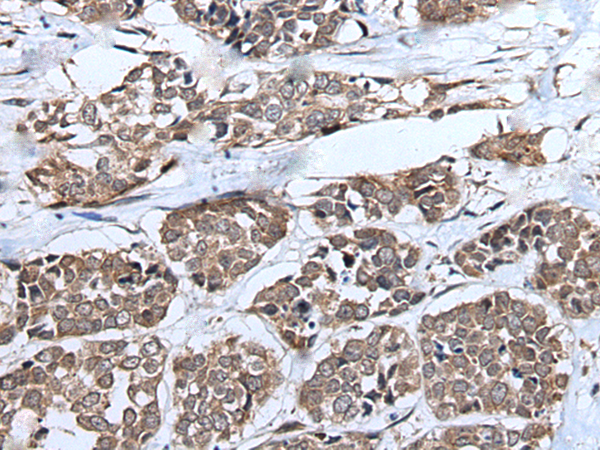 Immunohistochemistry of paraffin-embedded Human esophagus cancer tissue  using UBE4B Polyclonal Antibody at dilution of 1:40(×200)