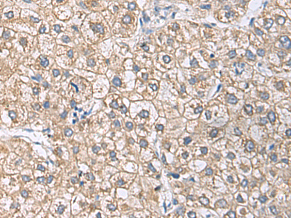 Immunohistochemistry of paraffin-embedded Human liver cancer tissue  using UBE2N Polyclonal Antibody at dilution of 1:55(×200)