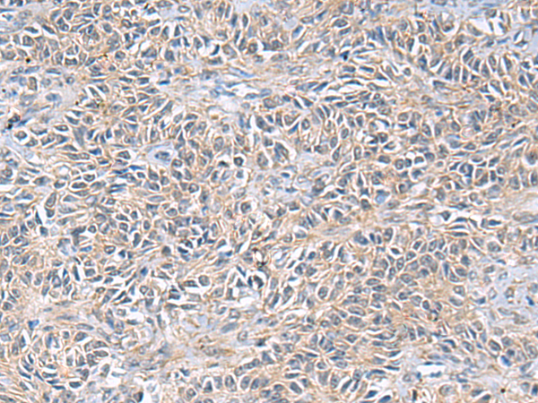 Immunohistochemistry of paraffin-embedded Human ovarian cancer tissue  using UBE2N Polyclonal Antibody at dilution of 1:55(×200)