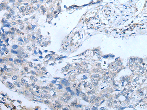 Immunohistochemistry of paraffin-embedded Human lung cancer tissue  using UBR4 Polyclonal Antibody at dilution of 1:65(×200)