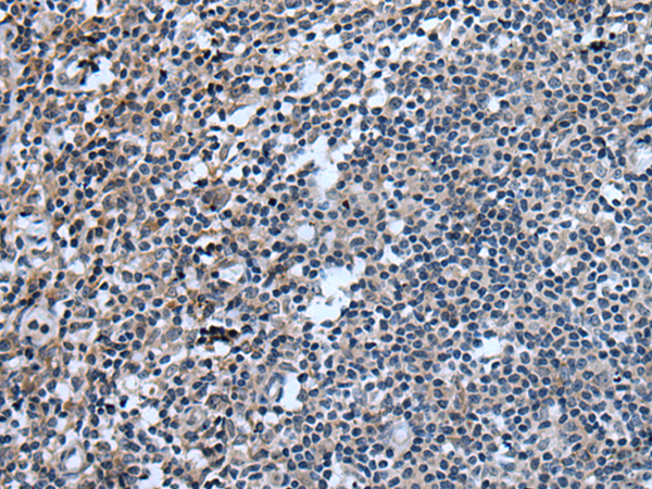 Immunohistochemistry of paraffin-embedded Human tonsil tissue  using UGT8 Polyclonal Antibody at dilution of 1:55(×200)