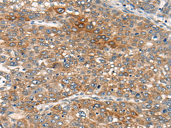 Immunohistochemistry of paraffin-embedded Human liver cancer tissue  using B4GAT1 Polyclonal Antibody at dilution of 1:110(×200)
