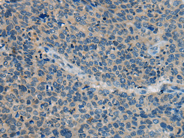 Immunohistochemistry of paraffin-embedded Human cervical cancer tissue  using BACE2 Polyclonal Antibody at dilution of 1:45(×200)