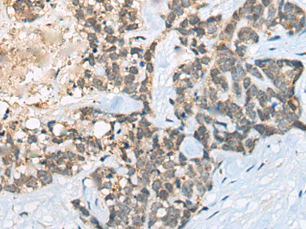 Immunohistochemistry of paraffin-embedded Human thyroid cancer tissue  using BACE2 Polyclonal Antibody at dilution of 1:45(×200)