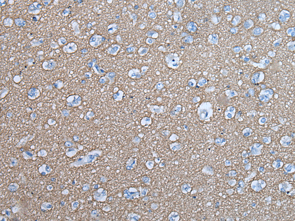 Immunohistochemistry of paraffin-embedded Human brain tissue  using SNCB Polyclonal Antibody at dilution of 1:45(×200)