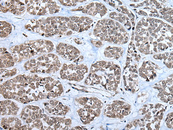 Immunohistochemistry of paraffin-embedded Human esophagus cancer tissue  using RPF2 Polyclonal Antibody at dilution of 1:40(×200)