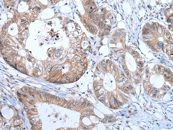Immunohistochemistry of paraffin-embedded Human colorectal cancer tissue  using PRSS50 Polyclonal Antibody at dilution of 1:65(×200)