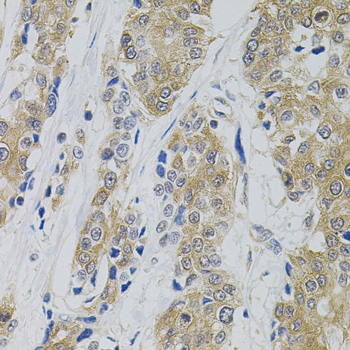 Immunohistochemistry of paraffin-embedded Human prostate cancer using DNM2 Polyclonal Antibody
