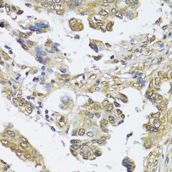 Immunohistochemistry of paraffin-embedded Human lung cancer using HDAC2 Polyclonal Antibody at dilution of  1:100 (40x lens).