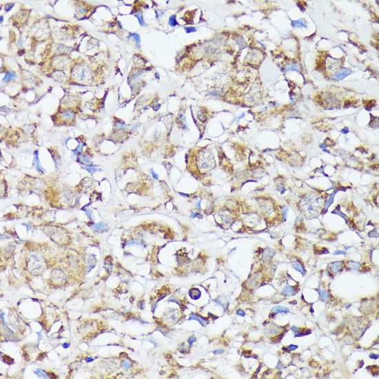 Immunohistochemistry of paraffin-embedded Human mammary cancer using MTHFD2 Polyclonal Antibody at dilution of  1:100 (40x lens).
