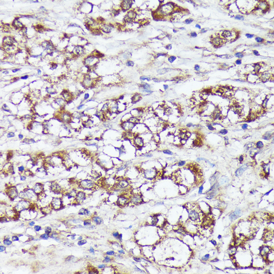 Immunohistochemistry of paraffin-embedded Human liver cancer using MTHFD2 Polyclonal Antibody at dilution of  1:100 (40x lens).