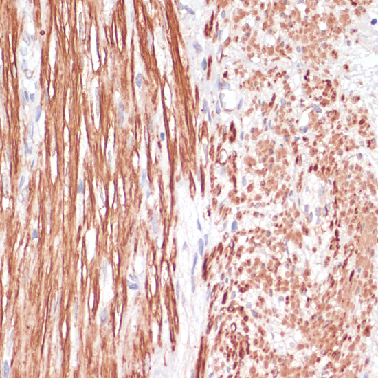 Immunohistochemistry of paraffin-embedded Human appendix using DES Polyclonal Antibody at dilution of  1:100 (40x lens).