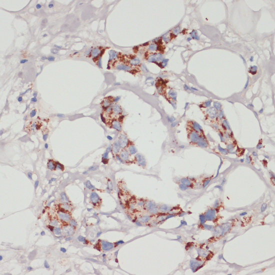 Immunohistochemistry of paraffin-embedded Human mammary cancer using ACSL3 Polyclonal Antibody at dilution of  1:100 (40x lens).