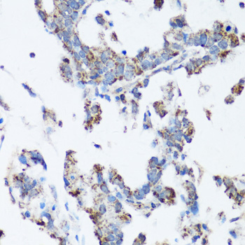 Immunohistochemistry of paraffin-embedded Human gastric cancer using SRC Polyclonal Antibody at dilution of  1:100 (40x lens).