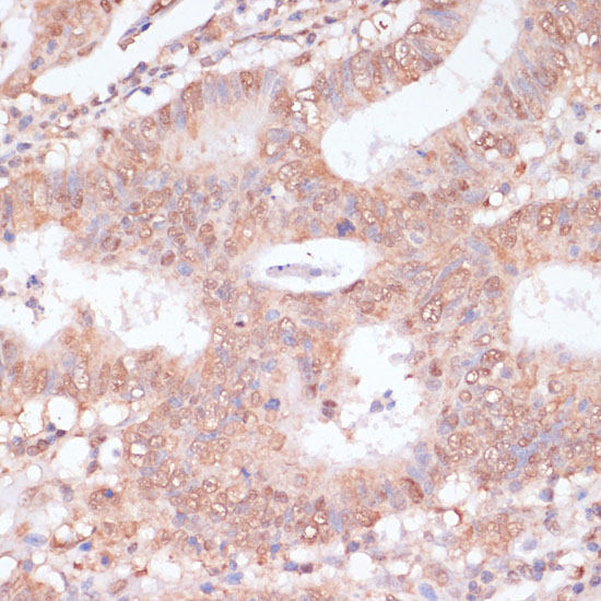 Immunohistochemistry of paraffin-embedded Human colon carcinoma using BYSL Polyclonal Antibody at dilution of  1:100 (40x lens).