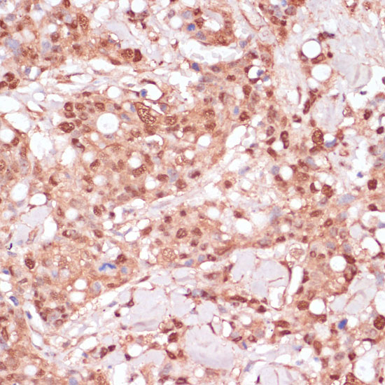 Immunohistochemistry of paraffin-embedded Human breast cancer using BYSL Polyclonal Antibody at dilution of  1:100 (40x lens).