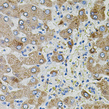 Immunohistochemistry of paraffin-embedded Human liver damage using TGFA Polyclonal Antibody
