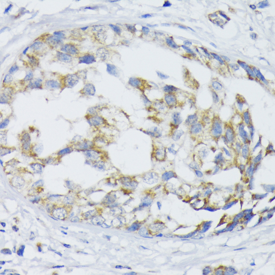 Immunohistochemistry of paraffin-embedded Human mammary cancer using SLC30A1 Polyclonal Antibody at dilution of  1:100 (40x lens).