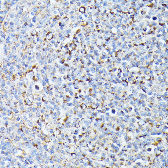 Immunohistochemistry of paraffin-embedded Human lymph node tumors using TP53I11 Polyclonal Antibody at dilution of  1:100 (40x lens).