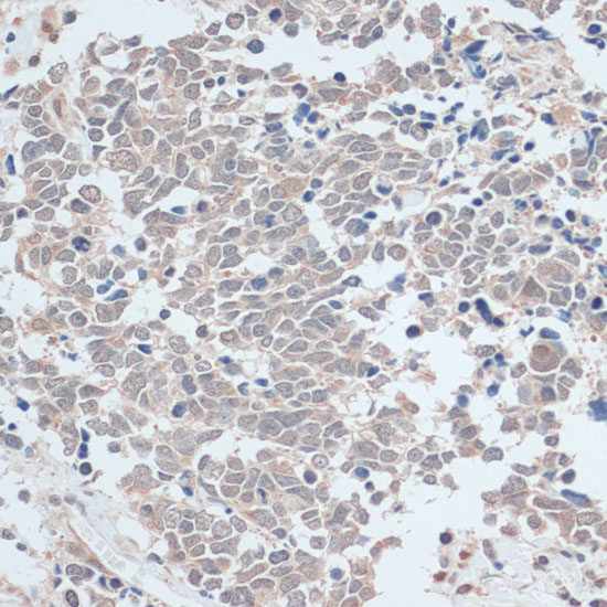 Immunohistochemistry of paraffin-embedded Human lung cancer using ZNF581 Polyclonal Antibody at dilution of  1:100 (40x lens).