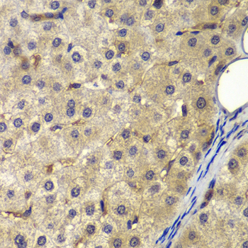 Immunohistochemistry of paraffin-embedded Human liver cancer using AP2A2 Polyclonal Antibody at dilution of  1:200 (40x lens).