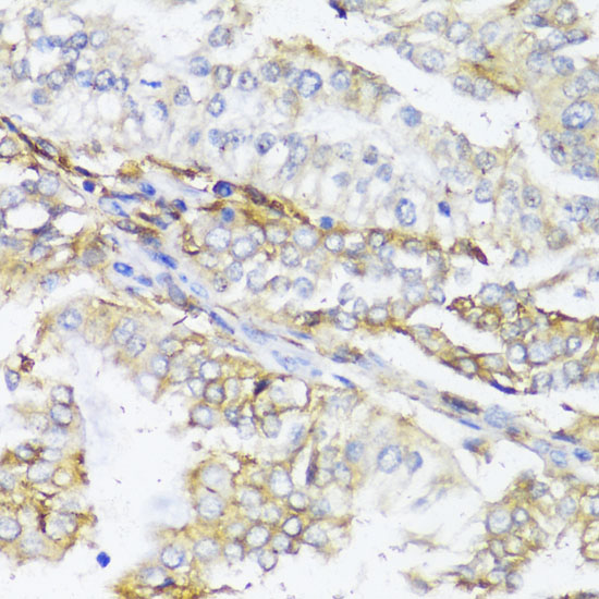 Immunohistochemistry of paraffin-embedded Human colon carcinoma using HLA-DPB1 Polyclonal Antibody at dilution of  1:100 (40x lens).