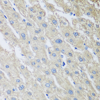 Immunohistochemistry of paraffin-embedded Human liver cancer using MLKL Polyclonal Antibody at dilution of  1:100 (40x lens).