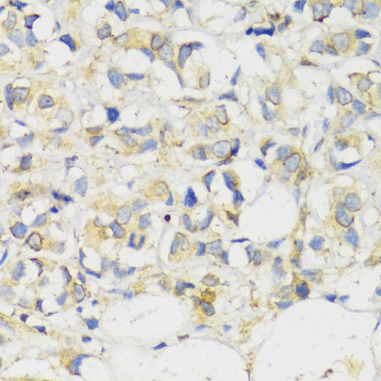 Immunohistochemistry of paraffin-embedded Human breast cancer using MLKL Polyclonal Antibody at dilution of  1:100 (40x lens).