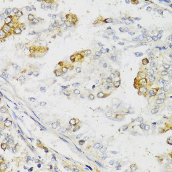 Immunohistochemistry of paraffin-embedded Human uterine cancer using MLKL Polyclonal Antibody at dilution of  1:100 (40x lens).