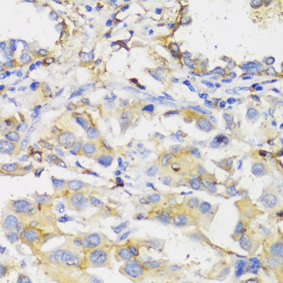 Immunohistochemistry of paraffin-embedded Human lung cancer using HLA-DPB1 Polyclonal Antibody at dilution of  1:100 (40x lens).