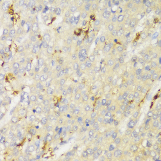 Immunohistochemistry of paraffin-embedded Human liver cancer using HLA-DPB1 Polyclonal Antibody at dilution of  1:100 (40x lens).