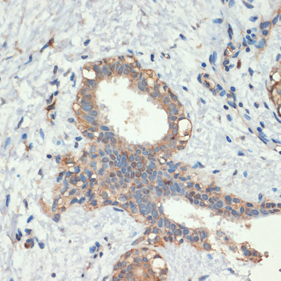 Immunohistochemistry of paraffin-embedded Human breast cancer using Smad5 Polyclonal Antibody at dilution of  1:200 (40x lens).