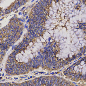 Immunohistochemistry of paraffin-embedded Human rectum cancer using EPHX2 Polyclonal Antibody at dilution of  1:200 (40x lens).