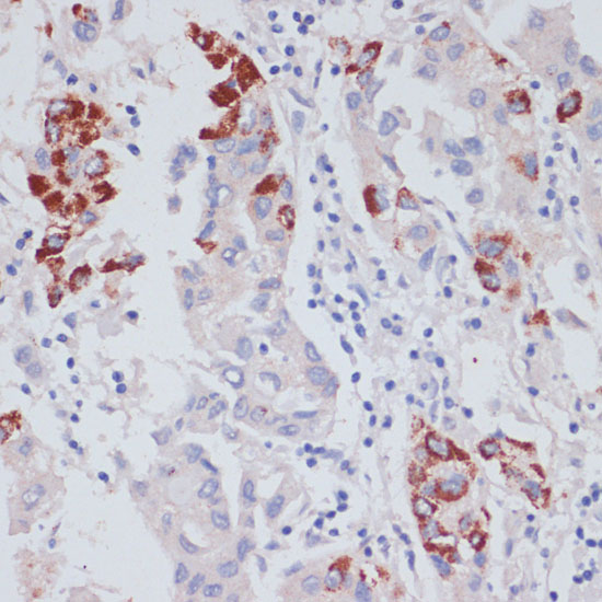 Immunohistochemistry of paraffin-embedded Human liver cancer using VASP Polyclonal Antibody at dilution of  1:100 (40x lens).