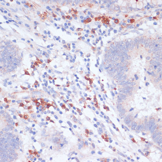 Immunohistochemistry of paraffin-embedded Human colon carcinoma using VASP Polyclonal Antibody at dilution of  1:100 (40x lens).