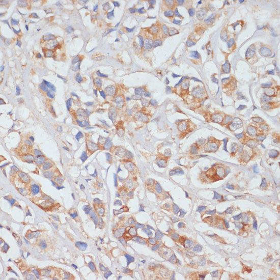 Immunohistochemistry of paraffin-embedded Human breast cancer using DLL1 Polyclonal Antibody at dilution of  1:100 (40x lens).