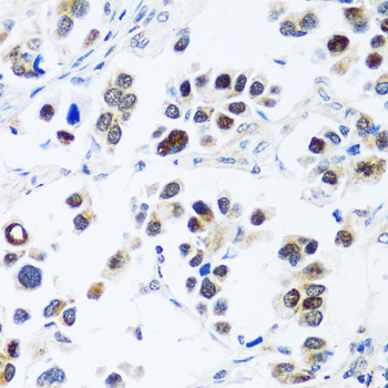 Immunohistochemistry of paraffin-embedded Human lung cancer using BRIX1 Polyclonal Antibody at dilution of  1:100 (40x lens).