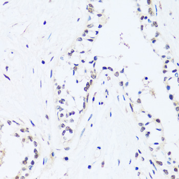 Immunohistochemistry of paraffin-embedded Human breast using BRIX1 Polyclonal Antibody at dilution of  1:100 (40x lens).