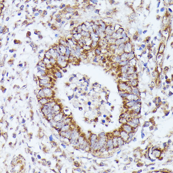 Immunohistochemistry of paraffin-embedded Human colon carcinoma using DLAT Polyclonal Antibody at dilution of  1:100 (40x lens).