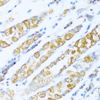 Immunohistochemistry of paraffin-embedded Human gastric cancer using NDUFA5 Polyclonal Antibody at dilution of  1:100 (40x lens).