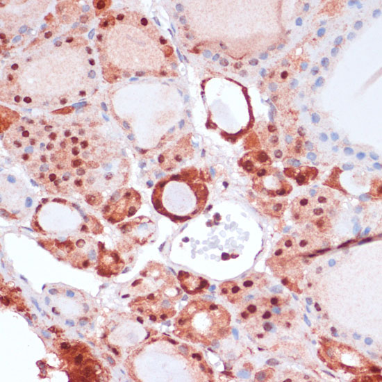 Immunohistochemistry of paraffin-embedded Human thyroid cancer using S100A5 Polyclonal Antibody at dilution of  1:100 (40x lens).