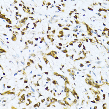 Immunohistochemistry of paraffin-embedded Human gastric cancer using ITGB3BP Polyclonal Antibody at dilution of  1:100 (40x lens).