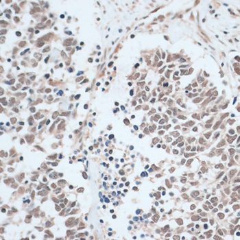 Immunohistochemistry of paraffin-embedded Human lung cancer using ZNF416 Polyclonal Antibody at dilution of  1:100 (40x lens).