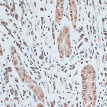 Immunohistochemistry of paraffin-embedded Human gastric cancer using ZNF416 Polyclonal Antibody at dilution of  1:100 (40x lens).