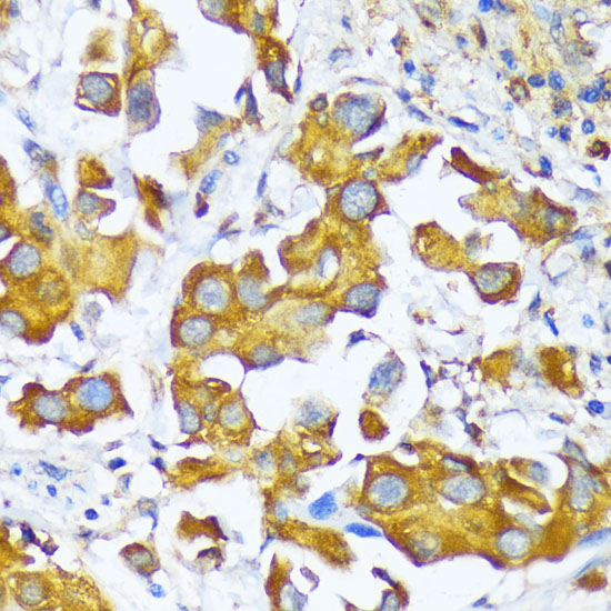 Immunohistochemistry of paraffin-embedded Human lung cancer using AARS Polyclonal Antibody at dilution of  1:100 (40x lens).