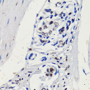 Immunohistochemistry of paraffin-embedded Human gastric cancer using p27 KIP 1 Polyclonal Antibody at dilution of  1:100 (40x lens).