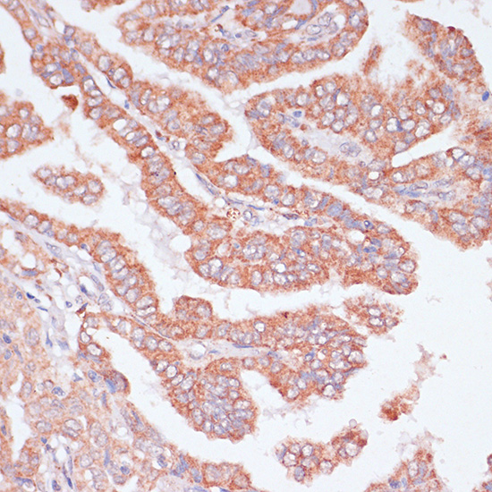 Immunohistochemistry of paraffin-embedded Human thyroid cancer using CDC20 Polyclonal Antibody at dilution of  1:100 (40x lens).