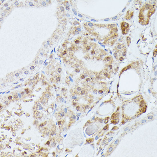 Immunohistochemistry of paraffin-embedded Human thyroid cancer using PPP2R5D Polyclonal Antibody at dilution of  1:100 (40x lens).